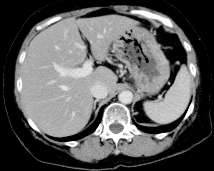 Diagnostic and therapeutic utility of gastric tissue culture in a case ...