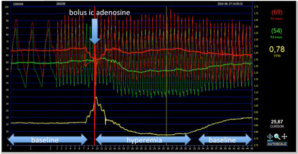 Catheter Based Functional Metrics Of The Coronary Circulation Springerlink