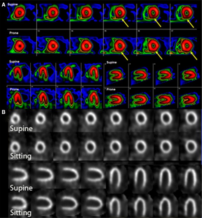 Assessment of Myocardial Viability Using Nuclear Medicine Imaging in  Dextrocardia