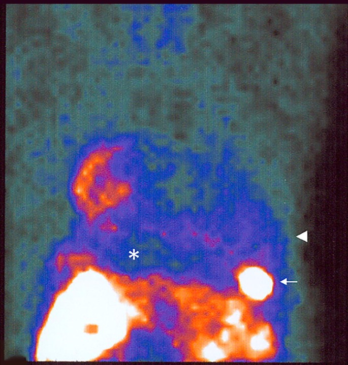 Assessment of Myocardial Viability Using Nuclear Medicine Imaging in  Dextrocardia