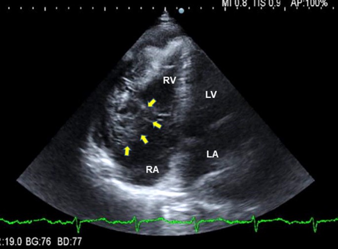 A case of primary cardiac lymphoma: Difficult to diagnose | SpringerLink