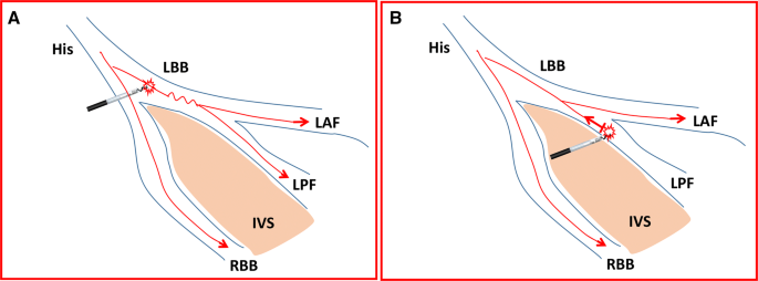 A Pilot Study To Determine If Left Ventricular Activation Time Is A Useful Parameter For Left Bundle Branch Capture Validated By Ventricular Mechanical Synchrony With Spect Imaging Springerlink