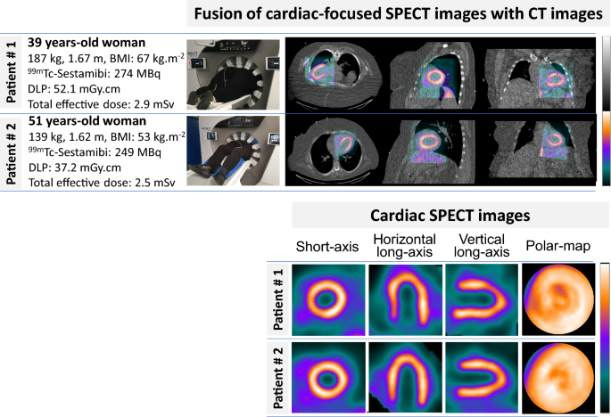 High Quality Attenuation Corrected Myocardial Perfusion Images May Be Achieved In Patients With Morbid Obesity Using A Whole Body Czt Camera And A Low Dose Injection Protocol Springerlink High Quality Attenuation Corrected Myocardial Perfusion Images May Be Achieved In Patients With Morbid Obesity Using A Whole Body Czt Camera And A Low Dose Injection Protocol Springerlink