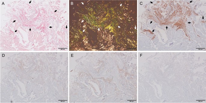 Atypical Case of Wild-Type Cardiac Amyloidosis with Septal Predominance and  a Nonapical Sparing Strain Pattern - CASE