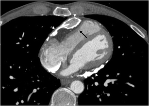 Ct Imaging Of The Pericardium Springerlink