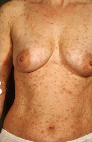 Voetschimmel in de navel