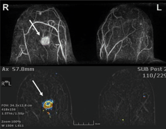 Mammaradiologie Welke Onderzoeken Vraagt De Huisarts Aan Springerlink