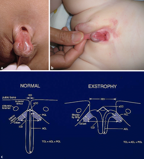 Congenitale Afwijkingen Aan De Urethra Hypospadie Epispadie Springerlink