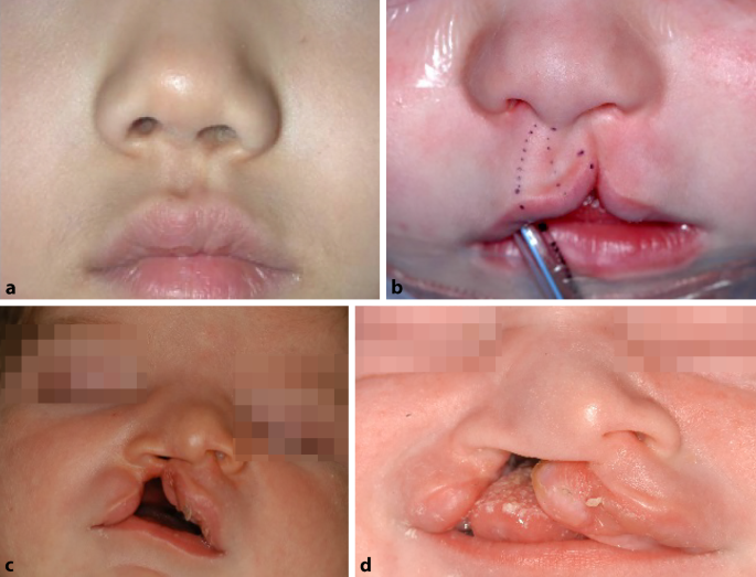 Chirurgische Behandeling Van Gespleten Lip En Verhemelte Springerlink