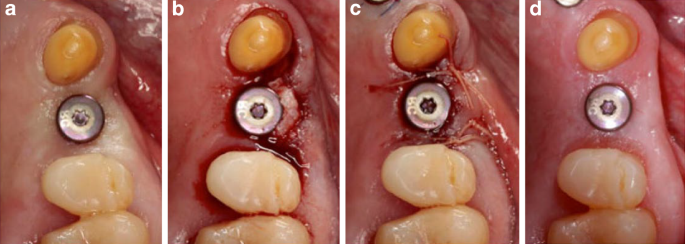 Implantologie Springerlink