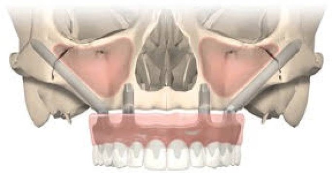 Implantologie Springerlink