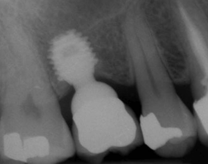 Implantologie Springerlink