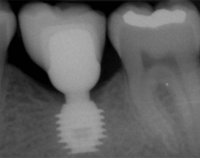 Implantologie Springerlink