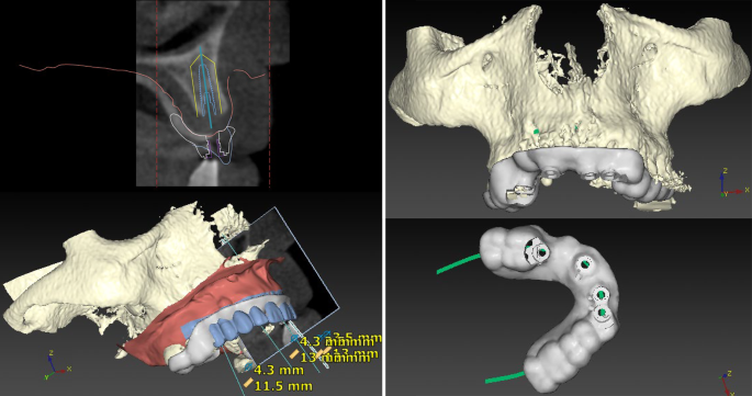 Implantologie Springerlink