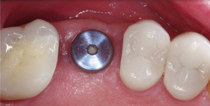 Implantologie Springerlink