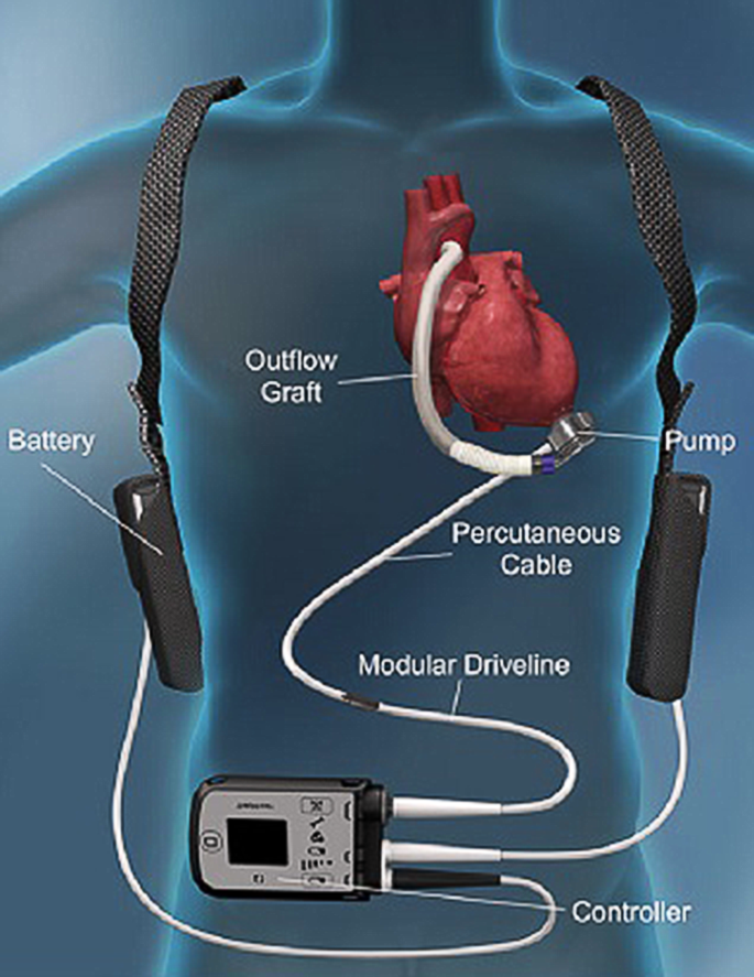 Ventricular Assist Devices: The Challenges of Outpatient Management -  ScienceDirect