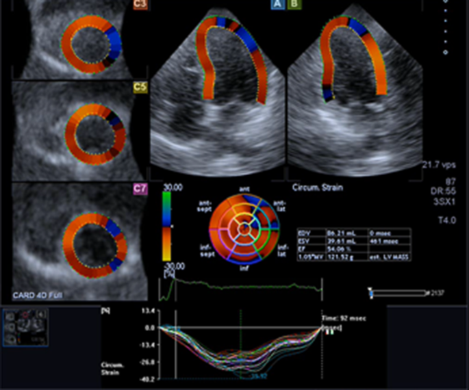 Strain Echocardiography in Acute Cardiovascular Diseases - The