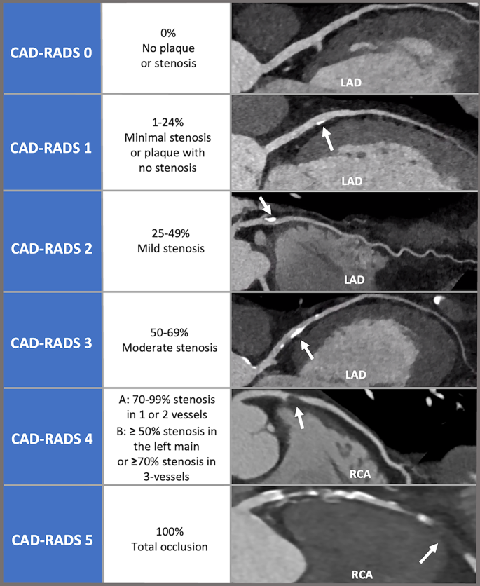 Moving towards a uniform diagnosis of coronary artery disease on ...