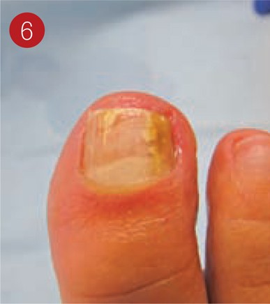 Hoe maak je een nagelriem vakkundig los? | SpringerLink