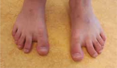 Geeft Scheefgroei Dig 2 Problemen Springerlink