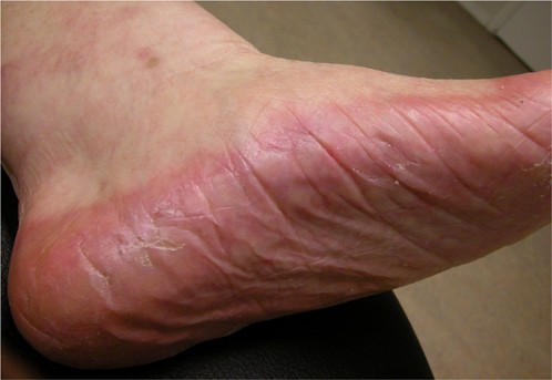 Ziektebeelden die roodheid aan de voeten veroorzaken | SpringerLink
