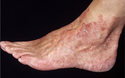 Ziektebeelden die roodheid aan de voeten veroorzaken | SpringerLink