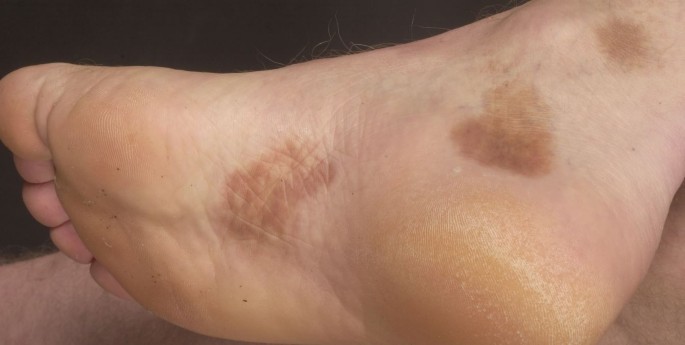 Een bruine kleur aan de voeten als gevolg van pigmentstapeling |  SpringerLink