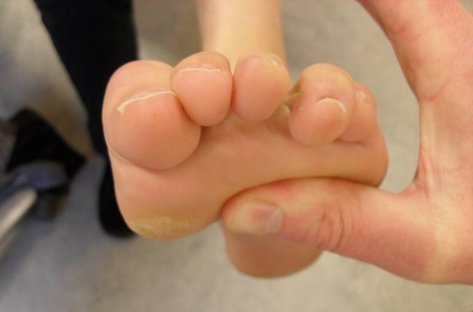 Gemakkelijker Hmsn Herkennen Dankzij De Nieuwe Richtlijn Springerlink