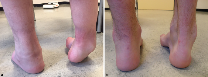 Gemakkelijker Hmsn Herkennen Dankzij De Nieuwe Richtlijn Springerlink