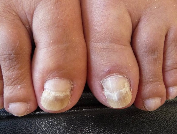 Invloed Van Medicatie Op Voeten En Huid Springerlink