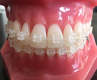 Orthodontische behandeling met onzichtbare beugels SpringerLink