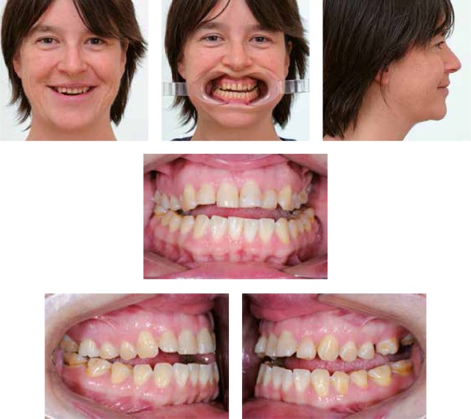 Samen Aan De Slag Bij Malocclusie Springerlink