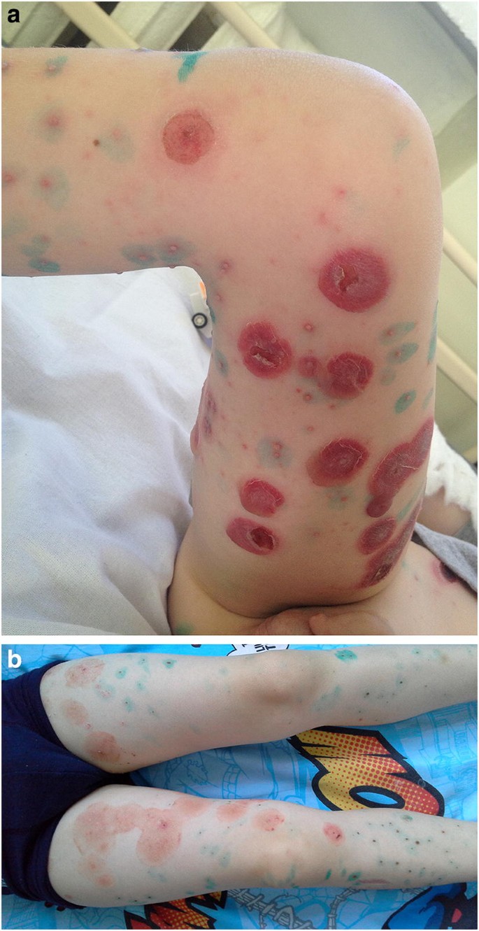 pic Day 1 Early Stage Chicken Pox Rash atypical severe presentation of