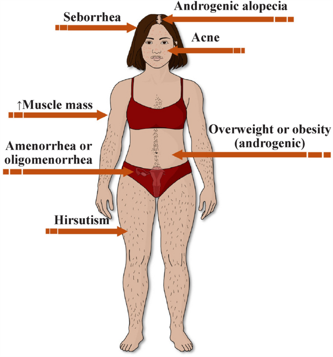 semaglutide reddit steroids Adolescent hyperandrogenism: diagnostic challenges and therapeutic  approaches | World Journal of Pediatrics