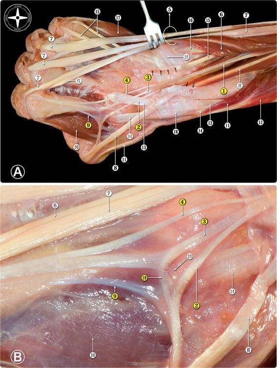 Extensor Pollicis Et Indicis Communis With Triple Slips In A Bilateral Case Of Accessory Muscles Of The Hand Springerlink