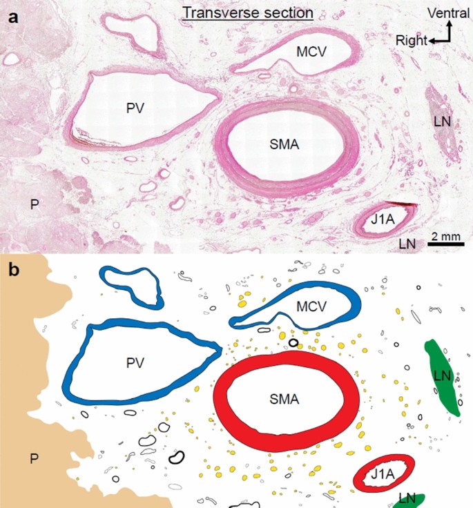 What Comprises The Plate Like Structure Between The Pancreatic Head And The Celiac Trunk And Superior Mesenteric Artery A Proposal For The Term P A Ligament Based On Anatomical Findings Springerlink What Comprises The Plate Like Structure Between The Pancreatic Head And The Celiac Trunk And Superior Mesenteric Artery A Proposal For The Term P A Ligament Based On Anatomical Findings Springerlink