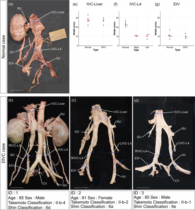 Histological characterization of the inferior vena cava in cases of ...
