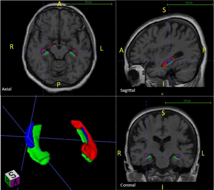 Morphometric evaluation of the human hippocampus and hippocampal ...