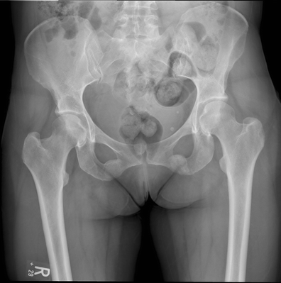 Atraumatic bilateral inferior pubic rami fractures in a young female: a  rare case | SpringerLink