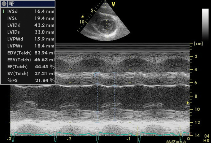 Role of echocardiography in assessing cardiac amyloidoses: a ...