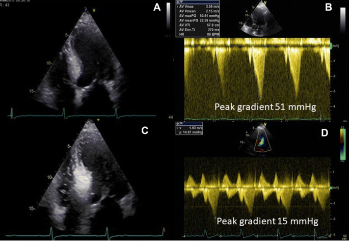 The role of echocardiography in management of hypertrophic cardiomyopathy |  SpringerLink
