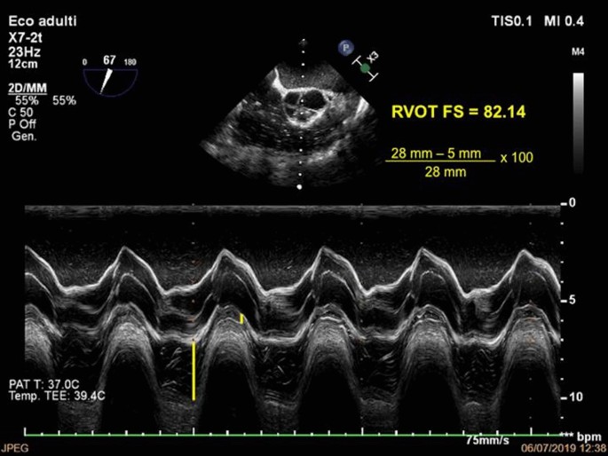 Acute left ventricular dysfunction complicating pregnancy on ECMO:  Tri-iodothyronine to the rescue with real time transesophageal  echocardiography - ScienceDirect