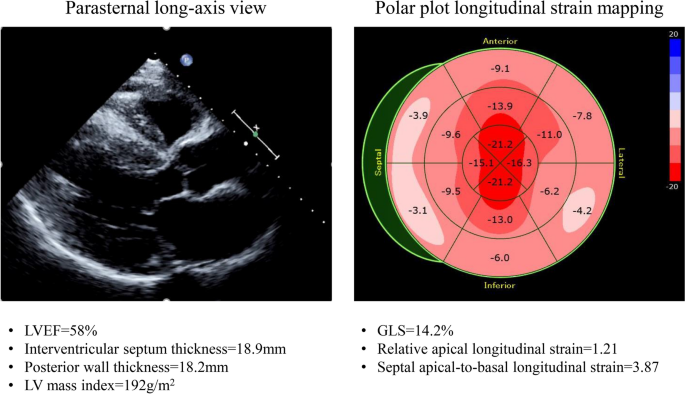 Relative apical sparing of longitudinal strain using two-dimensional  speckle-tracking echocardiography is both sensitive and specific for the  diagnosis of cardiac amyloidosis