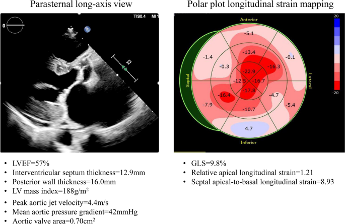 Left ventricular longitudinal strain abnormalities. (A) (apical