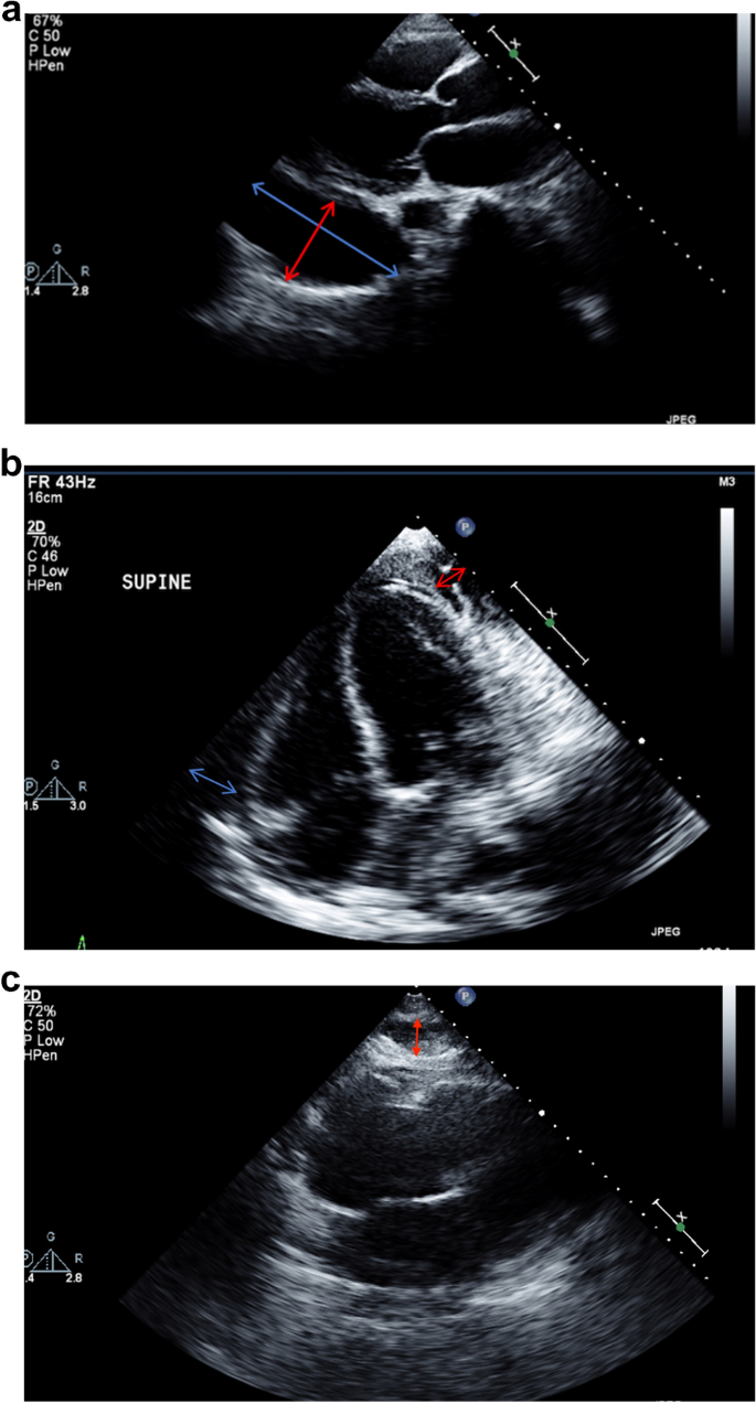 Quantification of pleural effusions by two-dimensional transthoracic  echocardiography | SpringerLink