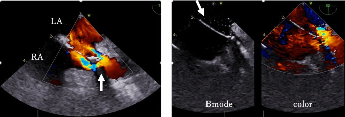 Contrast echocardiography proved useful in detecting abnormal flow ...