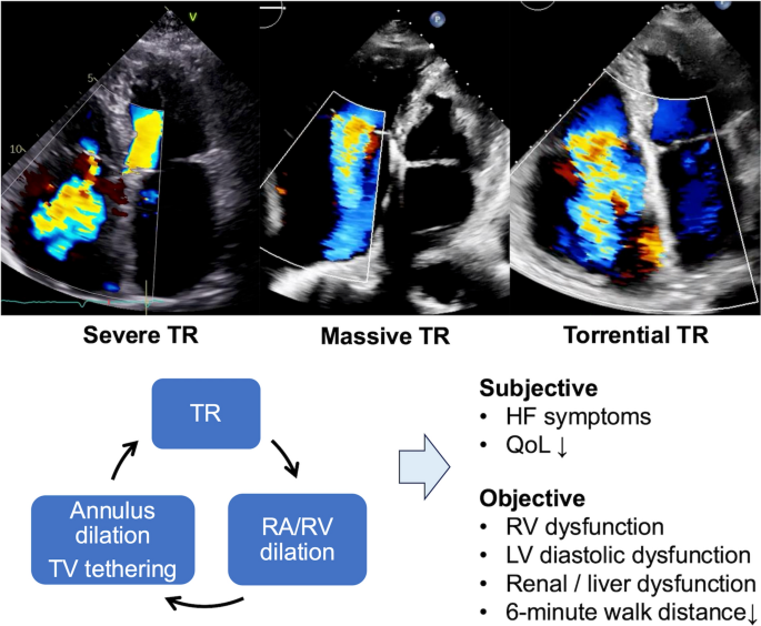Indication and timing in tricuspid interventions | Journal of ...
