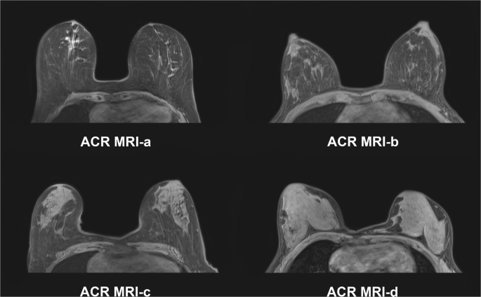 Multimodality Imaging Of Breast Parenchymal Density And Correlation With Risk Assessment Springerlink