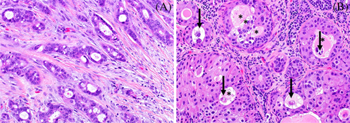 Radiologic and Pathologic Correlation of Invasive Lobular Carcinoma of the  Breast | SpringerLink