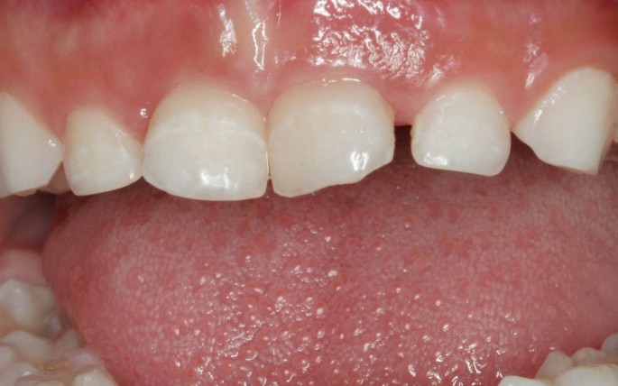 Fluoridanwendung Zur Karies Pravention Springerlink